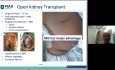 Robotic Kidney Transplant with Drs. Kumar & Kishore - Webinar