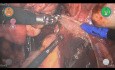 Endometriosis with Versius Robotic Platform - Circular Stapling
