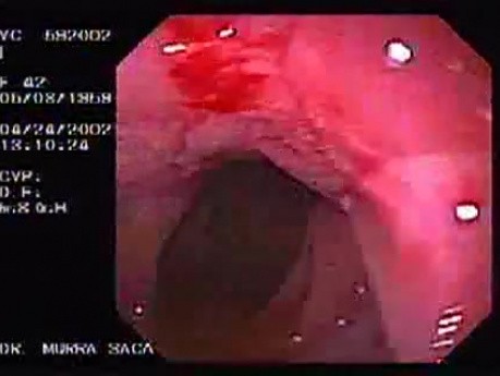 Crohn's Disease - Endoscopy (2 of 28)