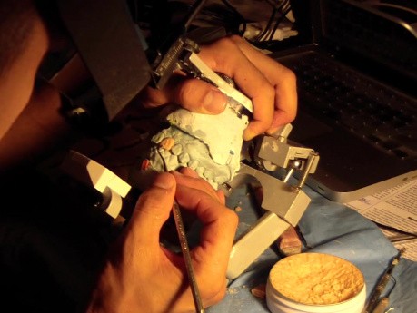 Diagnostic Waxup Part 11