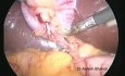 Three-Port Laparoscopic Cholecystectomy