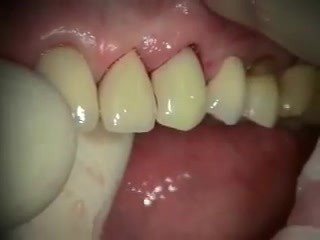 Immediate Implant #11 With Complications