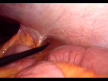 Colonic Perforation With Peritonitis - Laparoscopy (35 of 46)