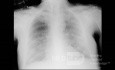 Coronavirus Chest X-Ray (4)