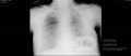 Coronavirus Chest X-Ray (4)