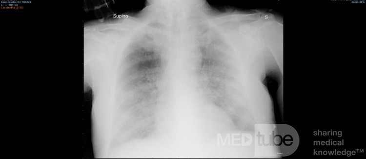 Coronavirus Chest X-Ray (4)