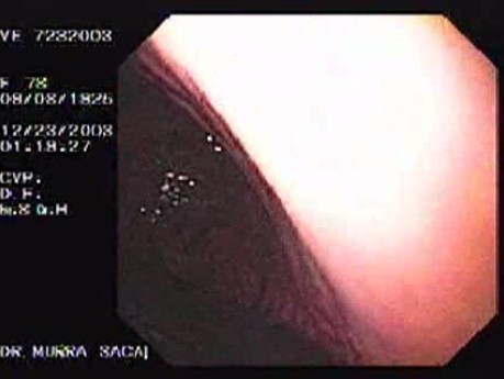 Hemorrhage Due Status Post Rubber Band Ligation of Esophageal Varices - Re-bleeding After Two Years