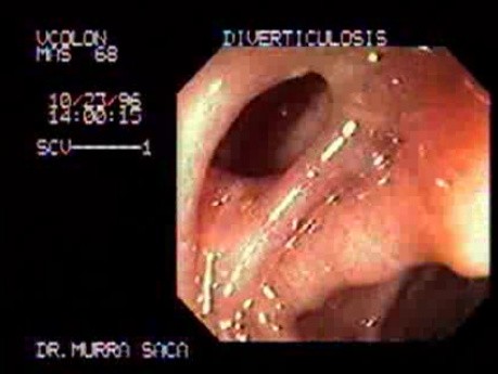 Melanosis Coli and Diverticulum