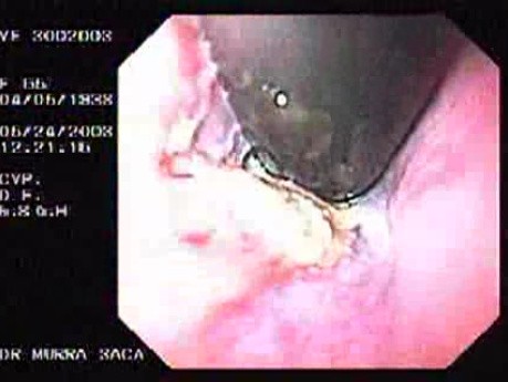Banding of Esophageal Varices - Cardias in Retroflexed View, Ulcerations and Necrosis, Part 1