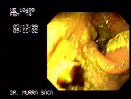 Gastric Adenocarcinoma - Obstruction 3