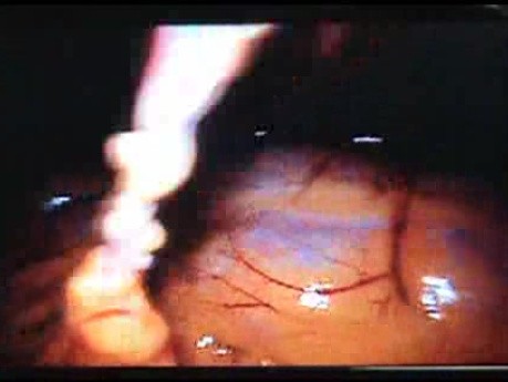 Jejunal Gastrointestinal Stromal tumor (GIST) (15 of 86)