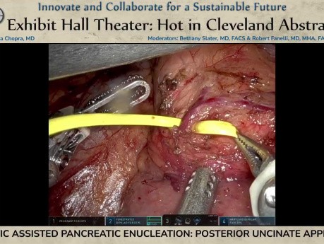 Robotic Assisted Pancreatic Enucleation Posterior Uncinate Approach