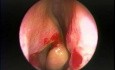 Anterior Bent Uncinate Process - Endoscopy