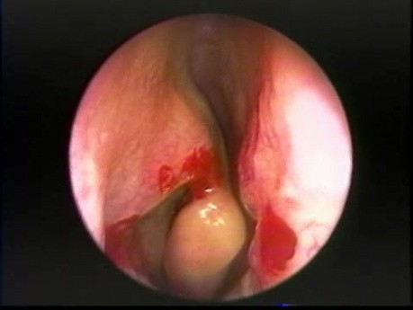 Anterior Bent Uncinate Process - Endoscopy