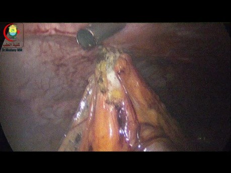 Adhesolysis Should Be With Scissor Only