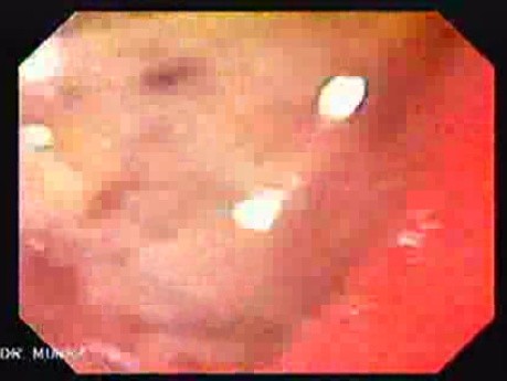Rectal Adenocarcinoma (9 of 12)