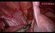 Appendectomy for Appendicitis in Child