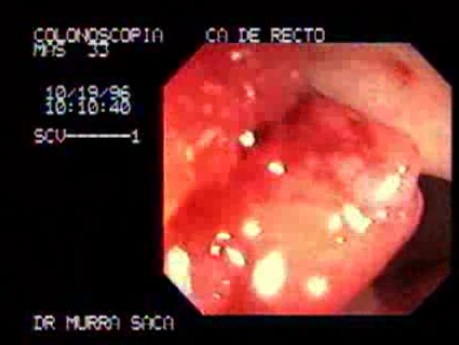 Rectal Adenocarcinoma