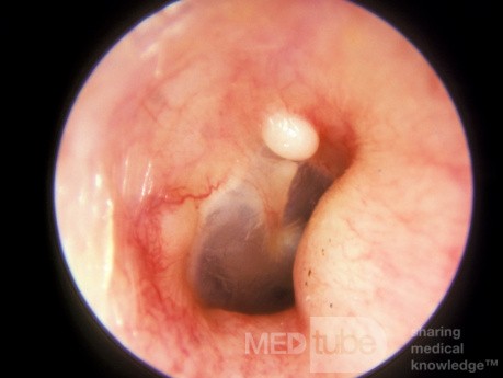 Small Solitary Exostosis of the External Ear Canal