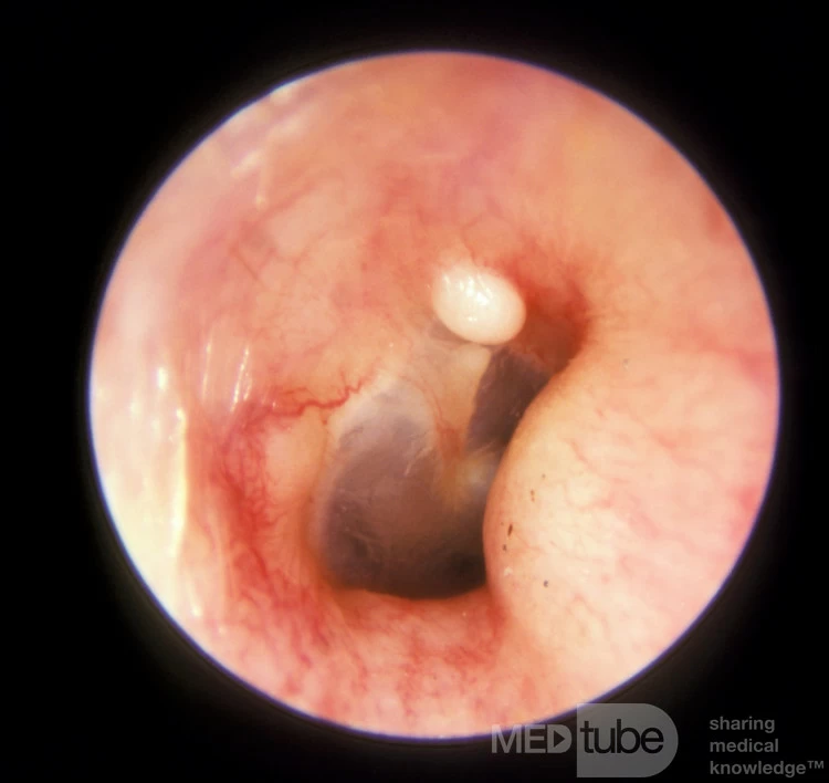 Small Solitary Exostosis of the External Ear Canal