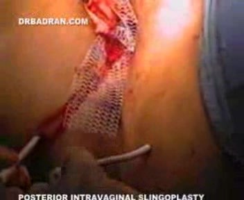 Posterior And Apical Vaginal Support With Mesh- Posterior Slingplasty
