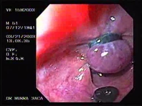 Banding of Esophageal Varices - Appearance of the Band