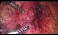 Laparoscopic Removal of Extra-adrenal Pheochromocytoma (Paraganglioma)