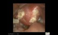 Application Of Hyaluronic Barrier Gel For Adhesion Prevention