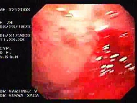 Dieulafoy´s Lesion (Exulceratio Simplex) (6 of 6)