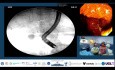 Why a Single Contrast Injection Can Be Fatal in Acute Cholangitis