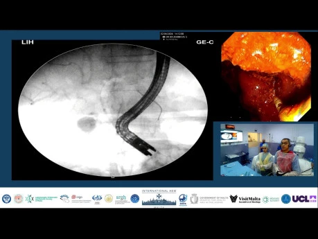 Why a Single Contrast Injection Can Be Fatal in Acute Cholangitis