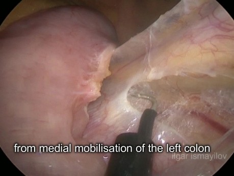 Laparoscopic D3 Sigmoidectomy with Left Colic Artery and Superor Rectal Artery Preservation