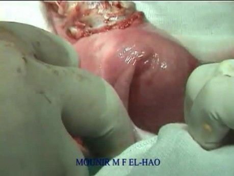 Excision of Leiomyomas - Separation From Endometrium
