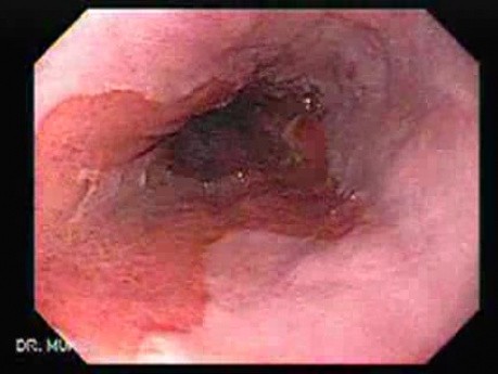 Endoscopic view of Barrett Esophagus -follow up endoscopy (8 of 9)