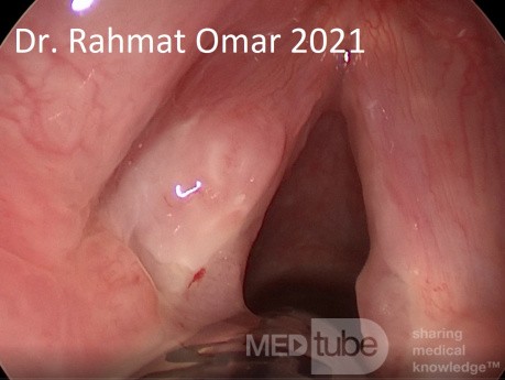 Tuberculous Laryngitis