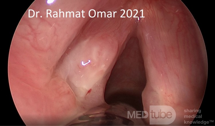 Tuberculous Laryngitis