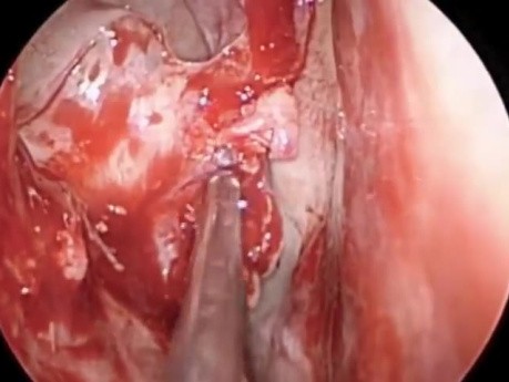 Ethmoid Mucopyocele - Middle Turbinate Concha Bullosa