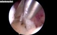Hysteroscopic Excision of Polyps