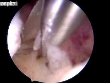 Hysteroscopic Excision of Polyps