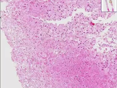 Herpes hepatitis