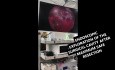 Minimal Frontal Craniectomy and Safe Maximum Surgical Tumor Resection