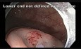 Adenoma Extending Into Appendix