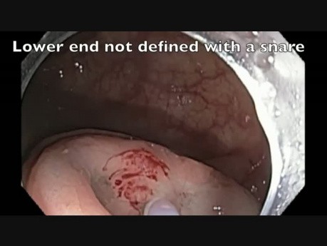 Adenoma Extending Into Appendix