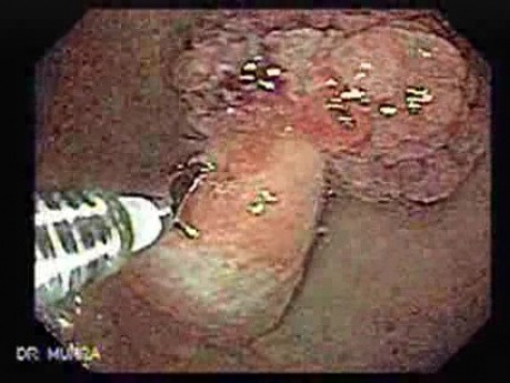 Multilobulated Gastric Polyp (6 of 20)
