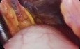 Laparoscopic total radical D2 gastrectomy