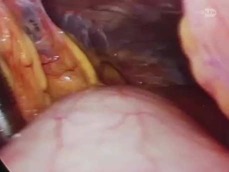 Laparoscopic total radical D2 gastrectomy