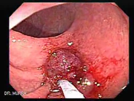 Endoscopic Appearance of Pedicled Polyp of the Descending Colon (5 of 7)