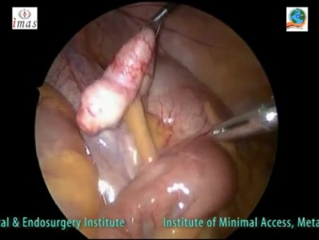 Single Incision Multi Port Laparoscopic Appendicectomy (SIMPLA)