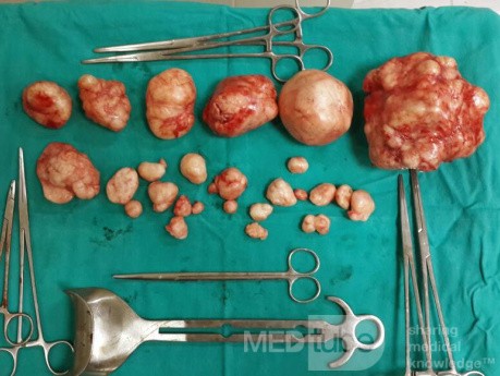Multiple Myomectomy Removed by Laparotomy in a Non Gravid Uterus