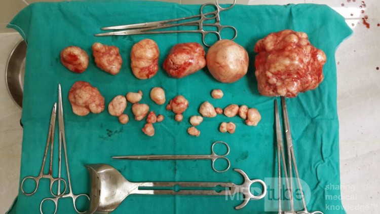 Multiple Myomectomy Removed by Laparotomy in a Non Gravid Uterus